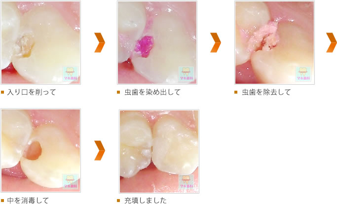 入り口を削って → 虫歯を染め出して → 虫歯を除去して → 中を消毒して → 充填しました