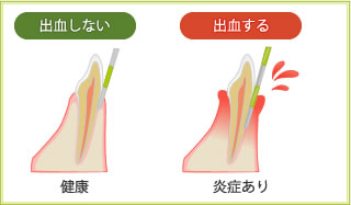 出血しない＝健康　出血する＝炎症あり