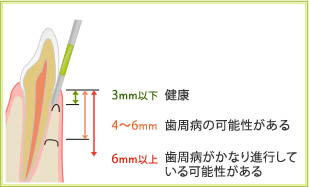 3mm以下＝健康　4～6mm歯周病の可能性がある　6mm以上歯周病がかなり進行している可能性がある