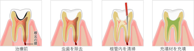 治療前→虫歯を除去→根管内を清掃→充墳材を充墳