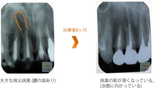 大きな根尖病巣 (膿の袋あり) → 治療後8ヶ月 → 病巣の影が薄くなっている。(治癒に向かっている)