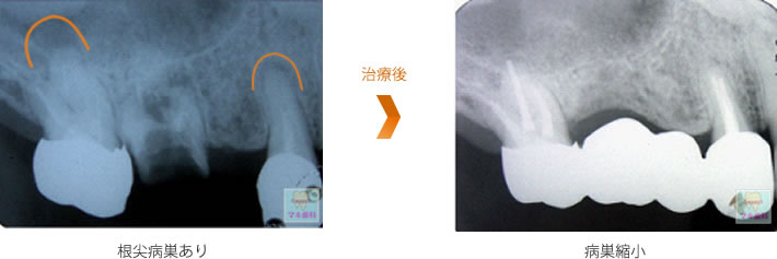 根尖病巣あり → 治療後 → 病巣縮小