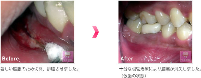 著しい腫脹のため切開、排膿させました。　→　十分な根管治療により膿痬が消失しました。（仮歯の状態）