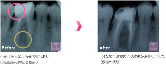 ○食片圧入による骨吸収もあり○広範囲の骨吸収像あり　→　十分な根管治療により膿痬が消失しました。（仮歯の状態）