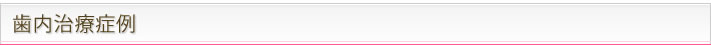 歯内治療例