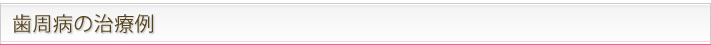 歯周病の治療例
