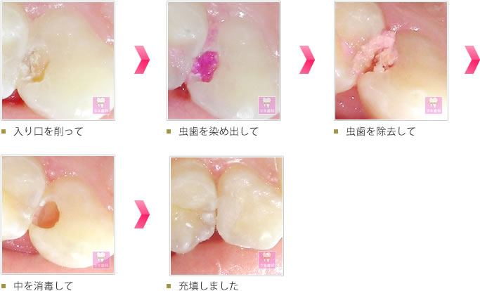 入り口を削って → 虫歯を染め出して → 虫歯を除去して → 中を消毒して → 充填しました