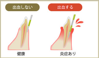 出血しない＝健康　出血する＝炎症あり