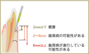 2mm以下＝健康　2～6mm歯周病の可能性がある　6mm以上歯周病が進行している可能性がある