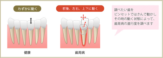 健康＝わずかに動く（生理的動揺）　歯周病＝前後・左右・上下に動く　／調べたい歯をピンセットではさんで動かしその時の
                    動く状態によって、歯周病の進行度を調べます。